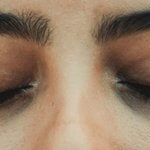 : how is it involved in glaucoma